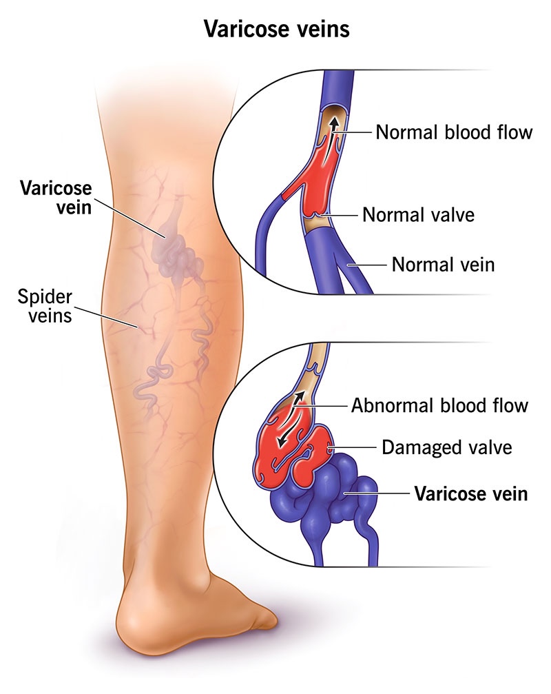 Varicose veins anatomy showing valve failure and blood pooling